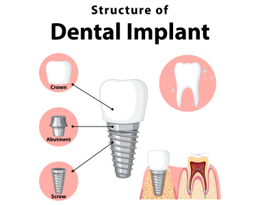 Dental Implants Cincinnati Ohio